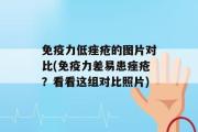 免疫力低痤疮的图片对比(免疫力差易患痤疮？看看这组对比照片)